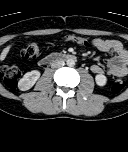 Infitrations rachidiennes epidurales et articulaires posterieures