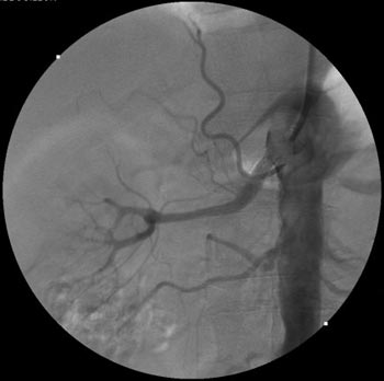 Angiographie - Angioplastie